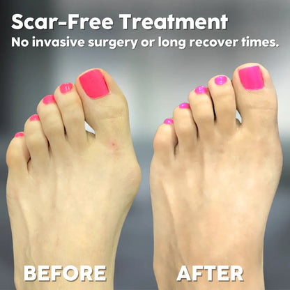 Bunion Corrector Soft Silicone Toe Aligner